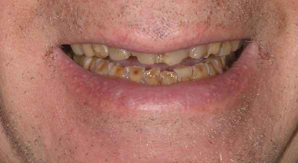Patient's smile before full mouth reconstruction