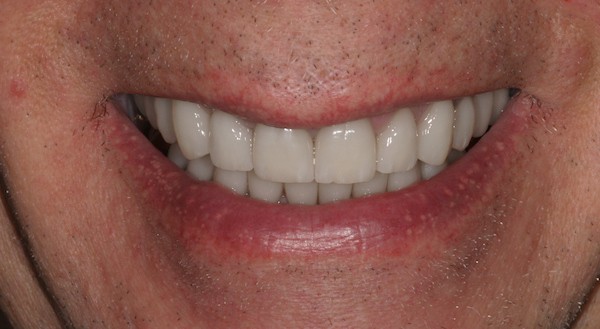 Patient's smile after full mouth reconstruction