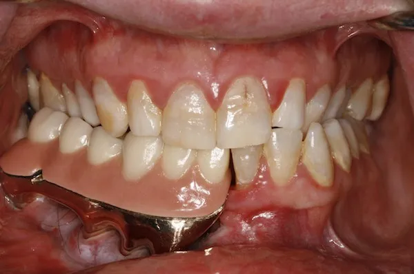 Maxillofacial prosthetic in a patient's mouth