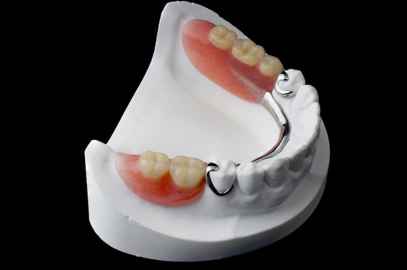 Partial denture in a mold